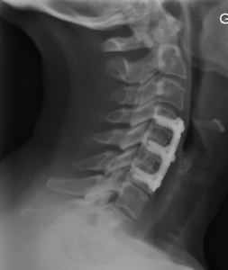 Cervical Spinal Fusion Surgery